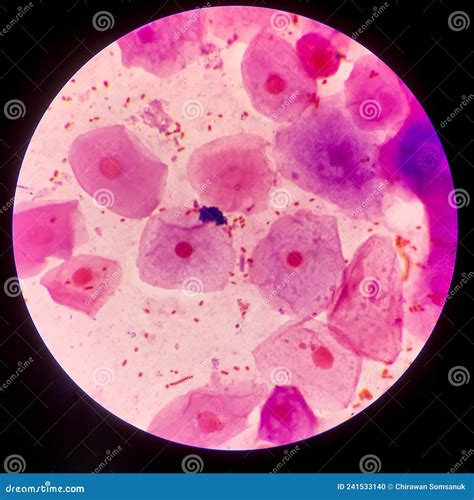 Bacteria Cell Gram Neagative Bacilli with Capsule.Sample Sputum in Gram ...