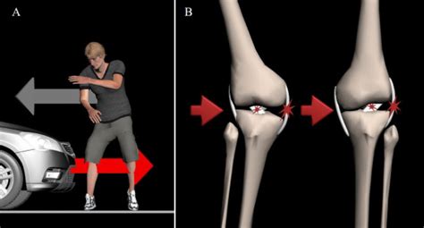 The risk of concomitant injuries of the contralateral side in valgus injured knee by lateral ...