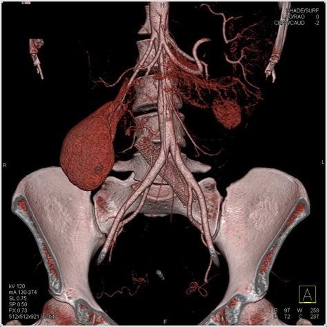 Stent in Left Iliac Vein in Patient with May–Thurner Syndrome - Vascular Case Studies - CTisus ...