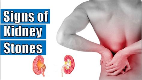 Signs of kidney stones | Symptoms of kidney stones - YouTube