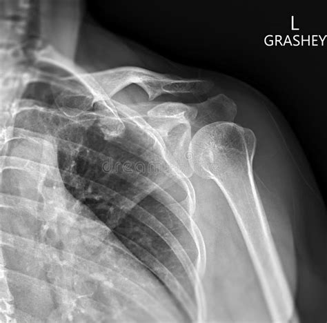 X-ray Shoulder Joint Shoulder Transaxillary View for Diagnosis Fracture of Shoulder Joint Stock ...