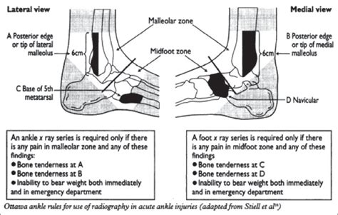 The Ottawa Ankle and Knee Rules — Thornleigh Performance Physiotherapy