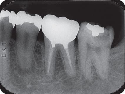 Non-surgical Root Canal Treatment Case V: Mandibular Premolar | Pocket ...