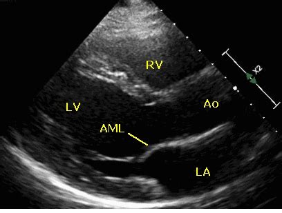 Parasternal long axis (PLAX) view in echocardiogram – animated view – All About Cardiovascular ...