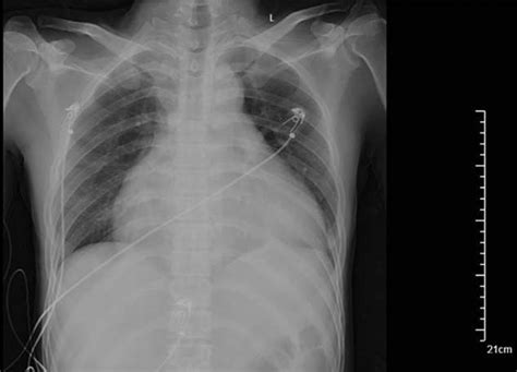 Repeated chest x-ray showing a large pericardial effusion. | Download Scientific Diagram