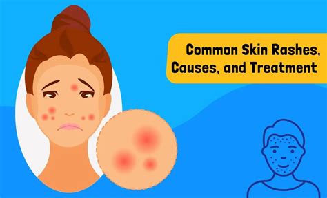 20 Common Skin Rashes, Causes, and Treatment - Resurchify