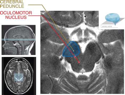 Brainstem Anatomy Mri