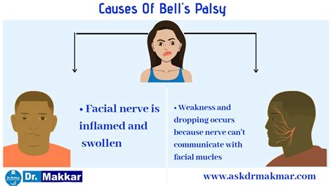 Bells palsy Homeopathic Treatment Idiopathic facial paralysis