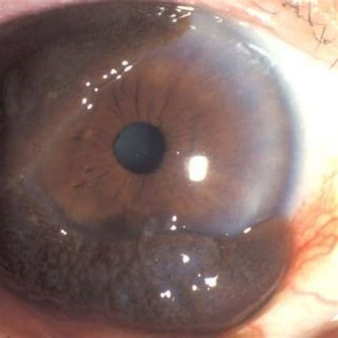 Conjunctival melanoma in the eye - OcuMel UK