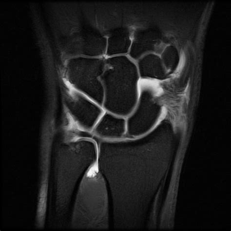 Tfcc Tear Mri - Goimages Inc