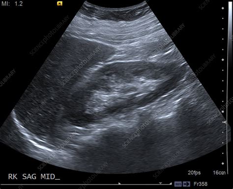 Normal Neonatal Kidney Ultrasound