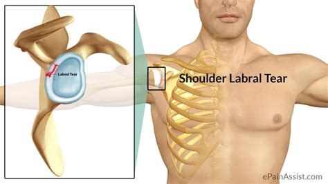 Shoulder Labral Tear - Motus Physical Therapy