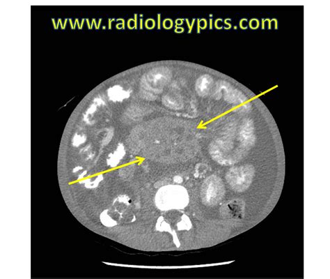 Solution to Unknown Case #21 – Mesenteric Lymphadenopathy Differential Diagnosis | RADIOLOGYPICS.COM