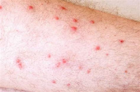 Tiny Red Spots on Skin (Petechiae), What Is This?