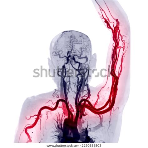 Brachial Arteries Arm Upper Extremity Bone Stock Illustration ...