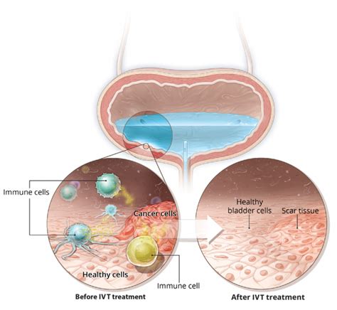 What is Intravesical Therapy? | Roswell Park Comprehensive Cancer Center - Buffalo, NY