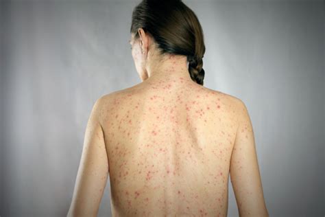 Measles case reported on Brisbane’s northside | Royal Brisbane and Women's Hospital