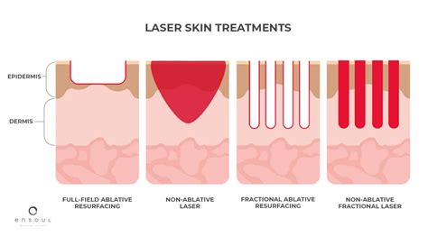 Fractional Laser