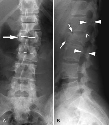 Burst Fracture | Radiology Key