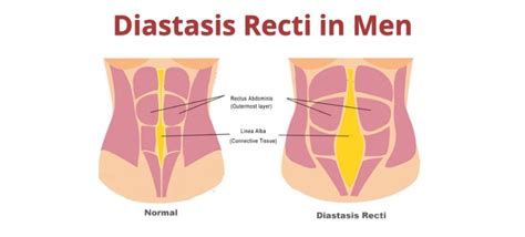 Diastasis Recti In Men | Symptoms | Causes | Exercise – Grow Health