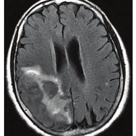 Sagittal MRI T2-FLAIR showing hyperintensity in the parasagittal region... | Download Scientific ...