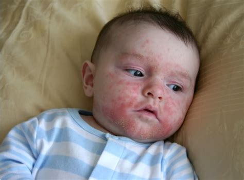 What is Infantigo (Impetigo) - Images, Treatment, Causes, Symptoms