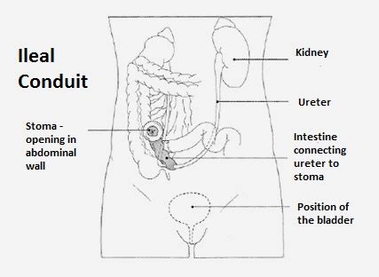 Action Bladder Cancer UK