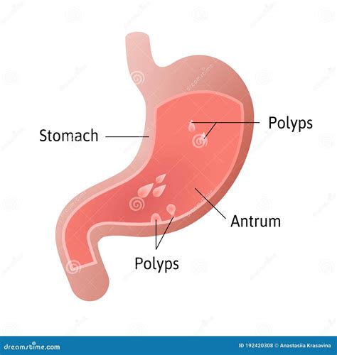 Gastric Polyps, Masses of Cells that Form on the Lining Inside Stomach ...