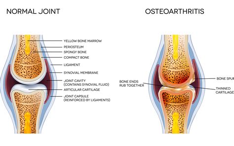 Arthritis, Osteochondrosis – Diseases of the Musculoskeletal System ...