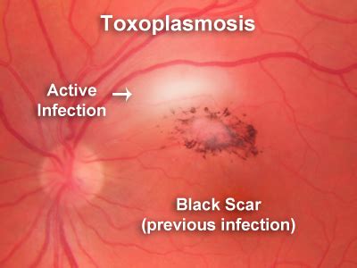 Toxoplasmosis – Retina Orange County