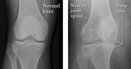 Findings on X-Rays Correlating to Knee Pain? A Blow to Pain Science? | Modern Manual Therapy ...