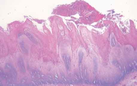 Verrucous carcinoma - Squamous Cell - ALPF Medical Research