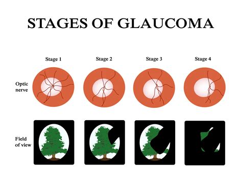 January Is National Glaucoma Awareness Month - San Simeon by the Sound