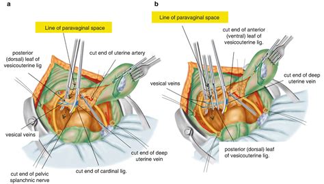 Points of Okabayashi’s Radical Hysterectomy | Obgyn Key