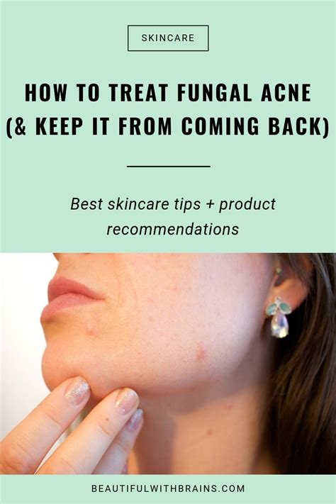 How To Treat Fungal Acne – Beautiful With Brains