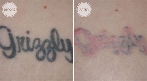 Natural Tattoo Removal: Effective Ways On How To Remove Tattoos At Home ...