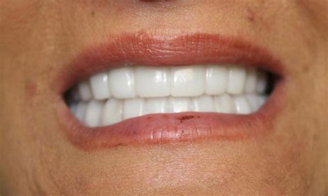 Snap-on-Smile (Upper and Lower) Before & After Photos | Rego Park NY