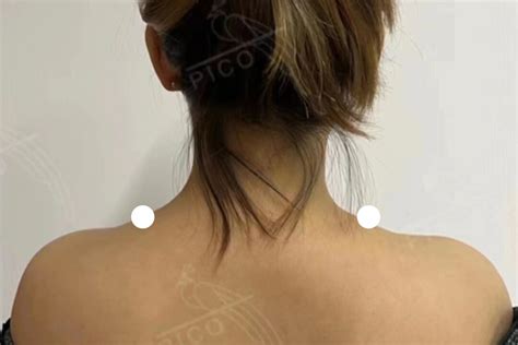 Shoulder Reduction Treatment | Pico Clinics