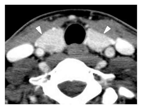 Normal thyroid designated “normal” CT diagnosis in a 28-year-old woman... | Download Scientific ...