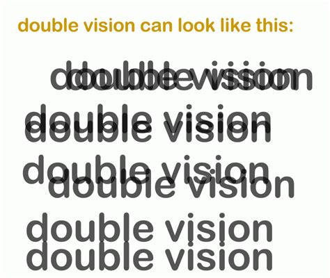 Double Vision (Diplopia): Causes, Symptoms & Treatment