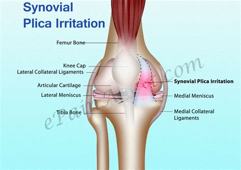 Synovial Plica | Etiology | Plica Snap | Leg presses | Knee Exercise | Leg