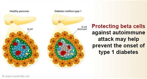 Type 1 Diabetes- Protecting Beta Cells Against Stress may Help