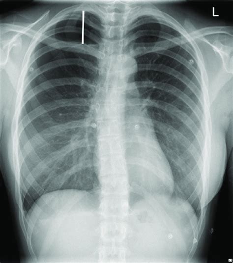 The ACCP pneumothorax guidelines classify pneumothorax size based on ...