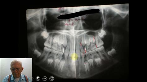 Second Molar Extraction Cases - YouTube