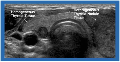 Ultrasound Thyroiditis