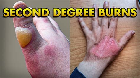 2nd Degree Burn: Superficial and Deep Partial Thickness Burns Explained ...