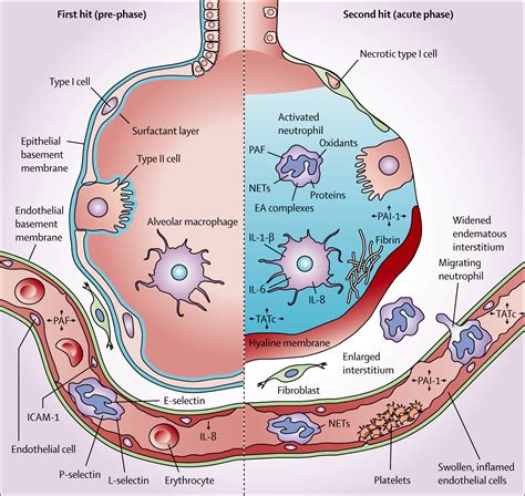 Transfusion-related acute lung injury: a clinical review - The Lancet