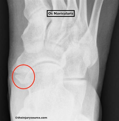 Os Navicularis (Accessory Navicular)