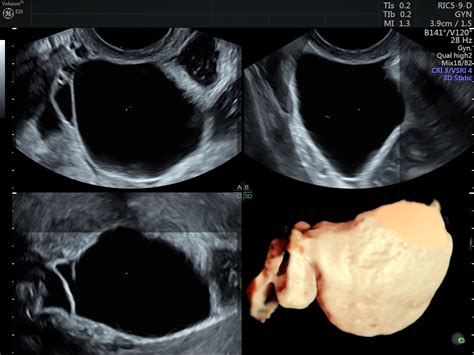 Tubal Ligation vs. Salpingectomy: Which Is Best? | Empowered Women's Health