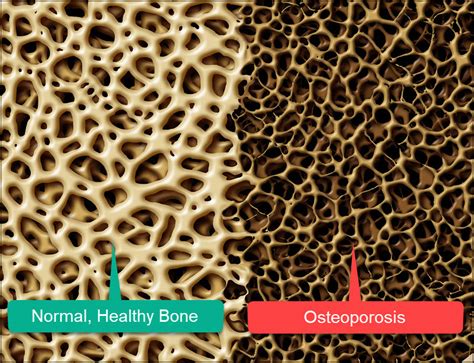 Osteoporosis & Bone Density